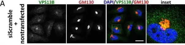 Fig.2.A showing Immunocytochemistry-immunofluorescence in a Homo sapiens (Human) sample from the publication: Disease relevance of rare VPS13B missense variants for neurodevelopmental Cohen syndrome.