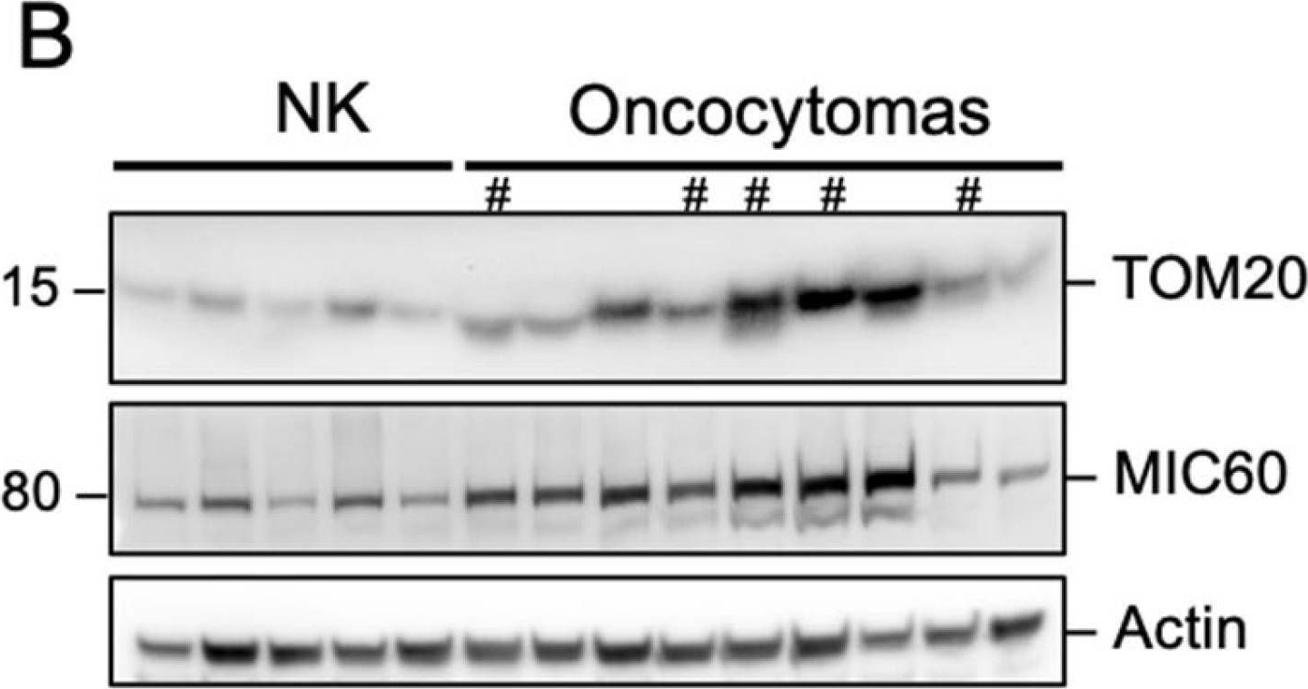 Fig.3.B showing Western Blotting in a Homo sapiens (Human) sample from the publication: The Loss of Complex I in Renal Oncocytoma Is Associated with Defective Mitophagy Due to Lysosomal Dysfunction.