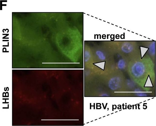 Lipid Storage and Interferon Response Determine the Phenotype of Ground Glass Hepatocytes in Mice and Humans.