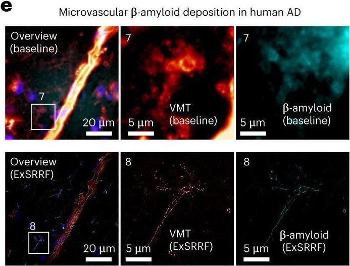 Fig.1.E showing Immunohistochemistry-immunofluorescence in a Homo sapiens (Human) sample from the publication: Expansion-enhanced super-resolution radial fluctuations enable nanoscale molecular profiling of pathology specimens.