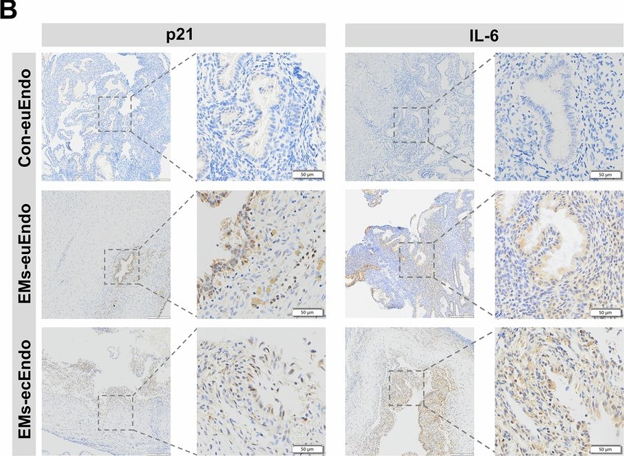 Fig.1.B showing Immunohistochemistry from the publication: FOSL2-driven SASP in endometrial stroma promotes the inflammation of endometriosis.