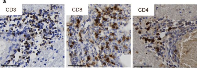 Fig.2.A showing Immunohistochemistry in a Homo sapiens (Human) sample from the publication: B-cell abundance in perivascular cuffs associates with local lesion activity in multiple sclerosis.