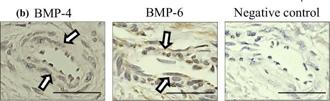 Fig.2.B showing Immunohistochemistry in a Homo sapiens (Human) sample from the publication: Immunohistochemical analysis revealed the expression of bone morphogenetic proteins-4, 6, 7, and 9 in human induced membrane samples treated with the Masquelet technique.