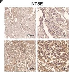 Fig.9.F showing Immunohistochemistry in a Homo sapiens (Human) sample from the publication: Integration of tumor microenvironment and metabolic signatures reveals TMPI-defined prognostic and immunotherapy-relevant phenotypes in breast cancer.