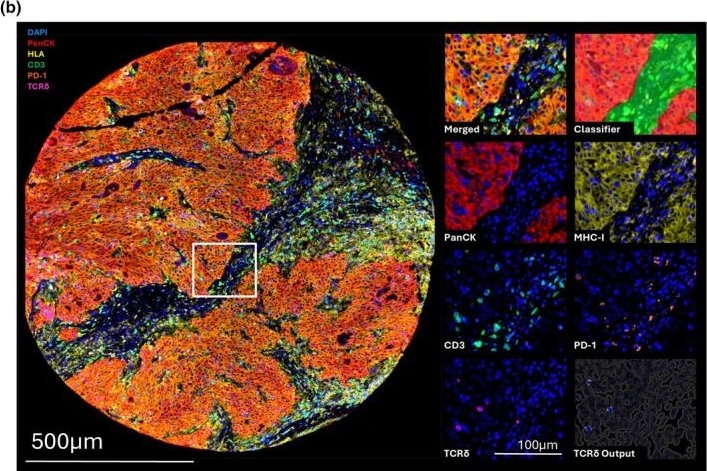 Fig.2.B showing Immunohistochemistry-immunofluorescence in an Equus caballus (Horse) sample from the publication: Characterisation of tumor-infiltrating gamma-delta T&nbsp;cells in human colorectal cancer with MHC-I loss.