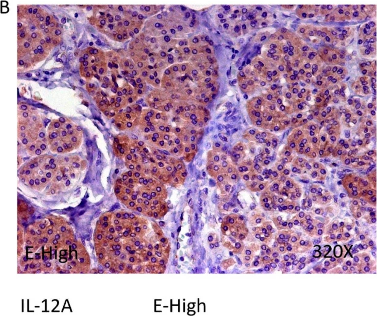 Fig.11.B showing Immunohistochemistry in a Homo sapiens (Human) sample from the publication: Prognostic Value of Histone Acetyl Transferase 1 (HAT-1) and Inflammatory Signatures in Pancreatic Cancer.