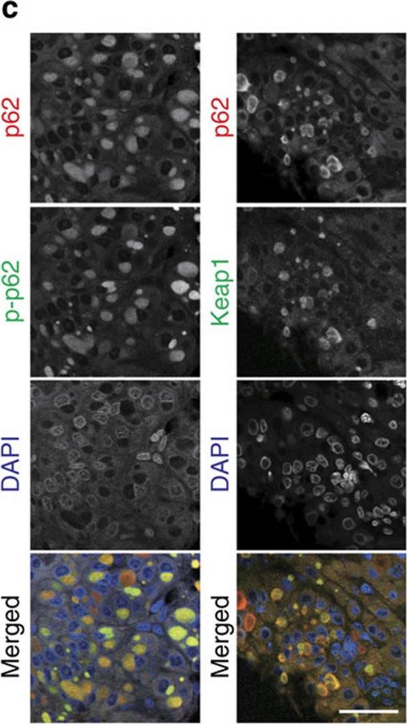 p62/Sqstm1 promotes malignancy of HCV-positive hepatocellular carcinoma through Nrf2-dependent metabolic reprogramming.
