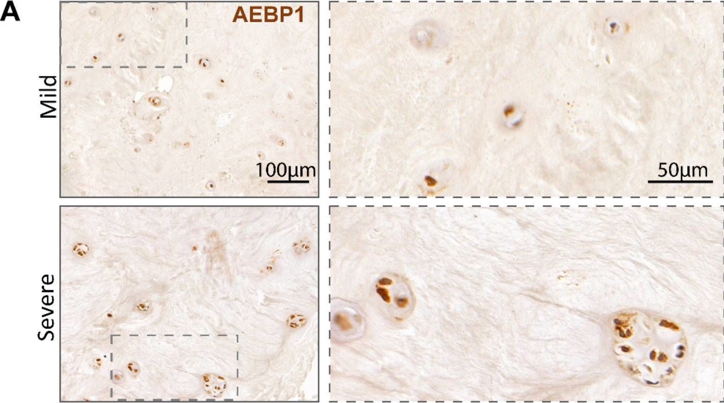 Fig.4.A showing Immunohistochemistry in a Homo sapiens (Human) sample from the publication: Proteomic profiling of human plasma and intervertebral disc tissue reveals matrisomal, but not plasma, biomarkers of disc degeneration.