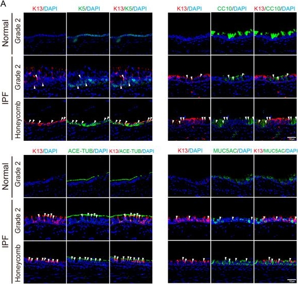 Fig.2.A showing Immunohistochemistry-immunofluorescence in a Homo sapiens (Human) sample from the publication: Spatial Distribution of K13-Positive Airway Epithelial Cells in Idiopathic Pulmonary Fibrosis.