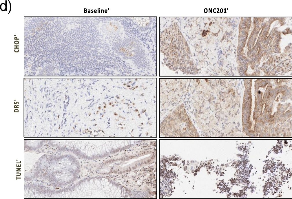 Fig.2.D showing Immunohistochemistry in a Homo sapiens (Human) sample from the publication: Safety and enhanced immunostimulatory activity of the DRD2 antagonist ONC201 in advanced solid tumor patients with weekly oral administration.