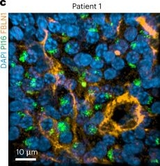 Fig.5.C showing Immunohistochemistry-immunofluorescence from the publication: PI16+ reticular cells in human palatine tonsils govern T cell activity in distinct subepithelial niches.