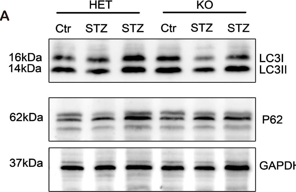 ADP-Ribosylation Factor-Interacting Protein 2 Acts as a Novel Regulator of Mitophagy and Autophagy in Podocytes in Diabetic Nephropathy.