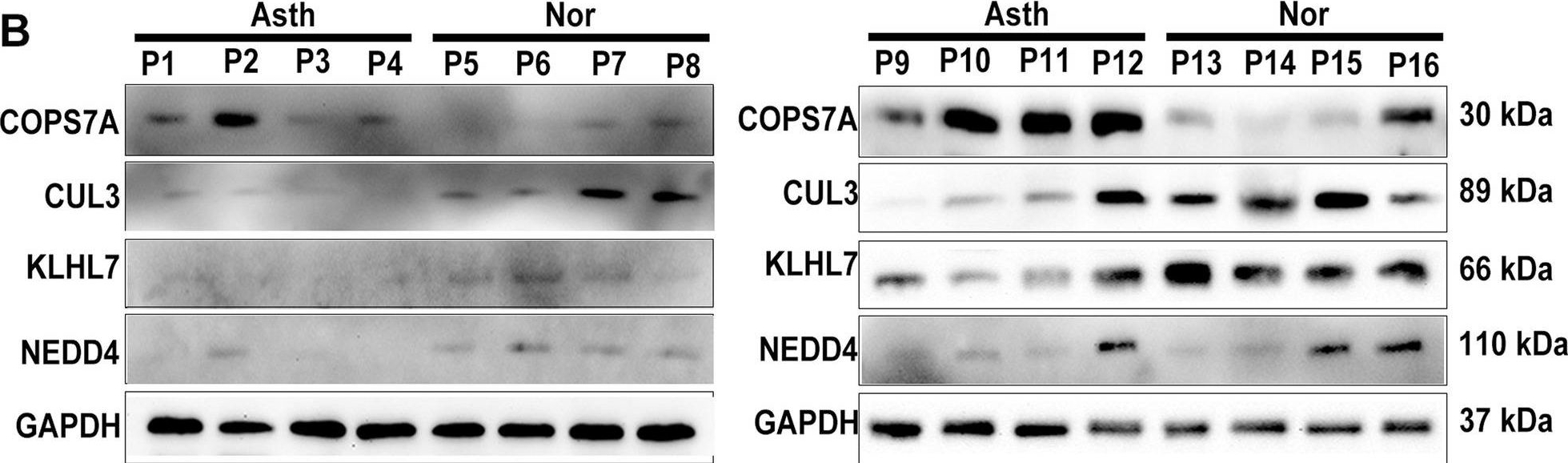 Fig.9.B showing Western Blotting from the publication: Bioinformatics analysis identifies potential hub genes and crucial pathways in the pathogenesis of asthenozoospermia.