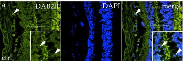 Fig.7.A showing Immunohistochemistry-immunofluorescence from the publication: Linking Megalin, Cubilin, Caveolin-1, GIPC1 and Dab2IP Expression to Ocular Tumorigenesis: Profiles in Retinoblastoma, Choroidal Melanoma, and the Normal Human Eye.