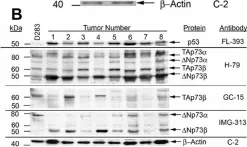Fig.2.B showing Western Blotting from the publication: Overexpressed TP73 induces apoptosis in medulloblastoma.