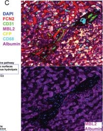 Fig.2.C showing Immunohistochemistry-immunofluorescence in a Homo sapiens (Human) sample from the publication: Exosome-Mediated Lectin Pathway and Resistin-MIF-AA Metabolism Axis Drive Immune Dysfunction in Immune Thrombocytopenia.