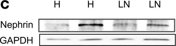 Aberrantly glycosylated IgG elicits pathogenic signaling in podocytes and signifies lupus nephritis. Aberrantly glycosylated IgG elicits pathogenic signaling in podocytes and signifies lupus nephritis.