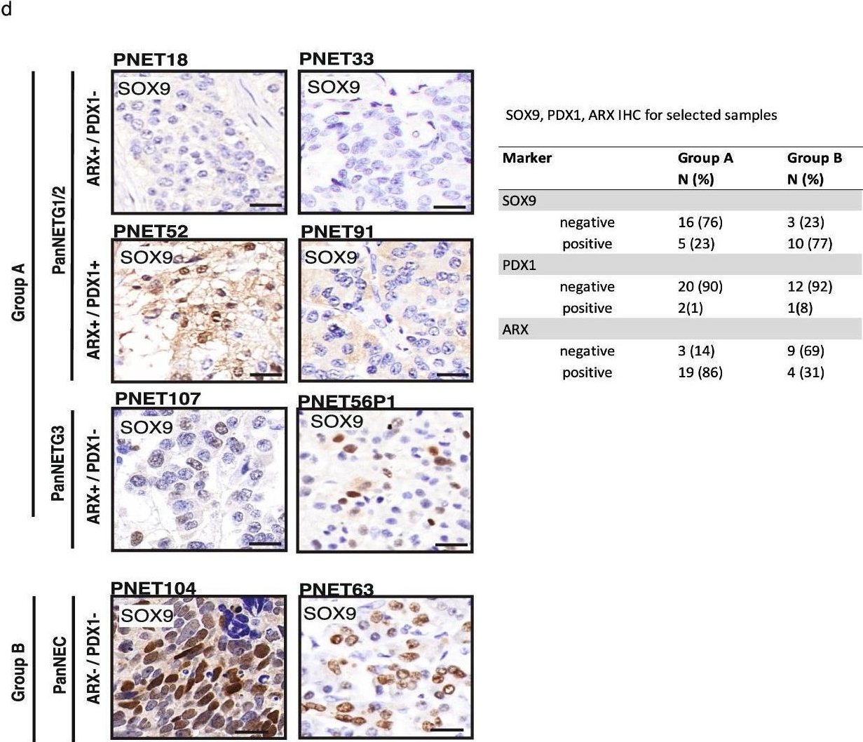 Fig.4.D showing Immunohistochemistry from the publication: DNA methylation reveals distinct cells of origin for pancreatic neuroendocrine carcinomas and pancreatic neuroendocrine tumors.