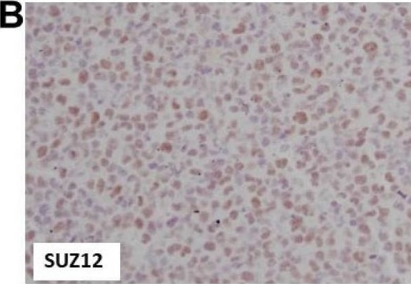 Fig.4.B showing Immunohistochemistry in a Homo sapiens (Human) sample from the publication: Upregulation of Enhancer of Zeste Homolog 2 (EZH2) with Associated pERK Co-Expression and PRC2 Complex Protein SUZ12 Correlation in Adult T-Cell Leukemia/Lymphoma.