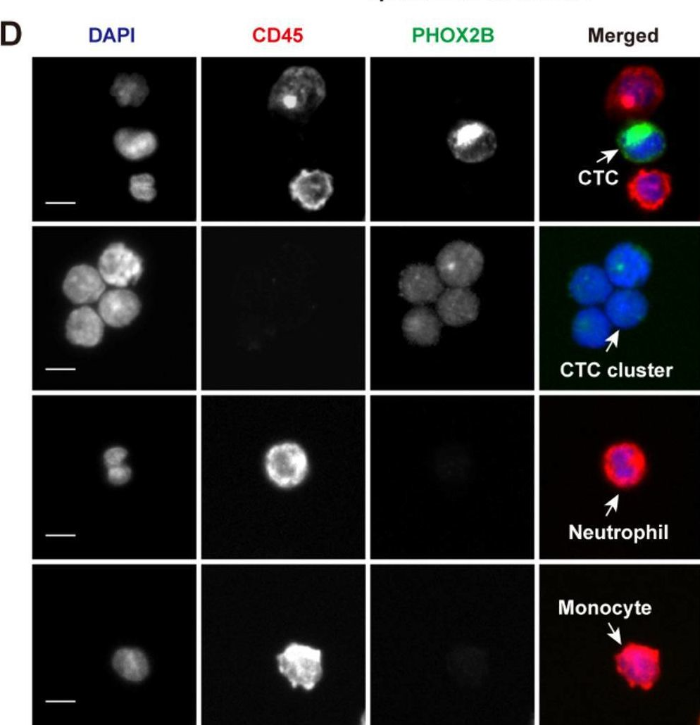 Fig.1.D showing Immunocytochemistry-immunofluorescence from the publication: Circulating tumor cells and clusters as liquid biomarkers for the diagnosis and prognosis of neuroblastoma.