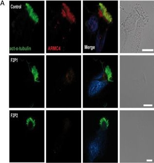 Fig.4.A showing Immunocytochemistry-immunofluorescence in a Homo sapiens (Human) sample from the publication: Novel pathogenic variant in ARMC4 identified by whole exome sequencing in a Turkish family with primary ciliary dyskinesia.