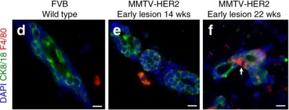 Macrophages orchestrate breast cancer early dissemination and metastasis.