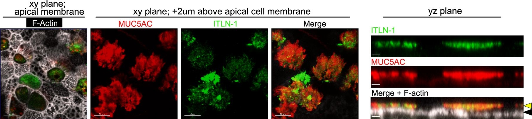 Fig.1.G showing Immunohistochemistry-immunofluorescence in a Homo sapiens (Human) sample from the publication: A common polymorphism in the Intelectin-1 gene influences mucus plugging in severe asthma.