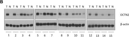 Fig.1.B showing Western Blotting from the publication: The Role of the Carnitine/Organic Cation Transporter Novel 2 in the Clinical Outcome of Patients With Locally Advanced Esophageal Carcinoma Treated With Oxaliplatin.