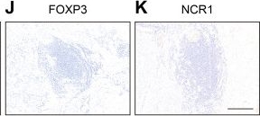 Fig.4.J showing Immunohistochemistry from the publication: Comprehensive analysis based on tertiary lymphoid structures and tumor budding predicts survival rates in colorectal cancer patients with synchronous liver metastases.