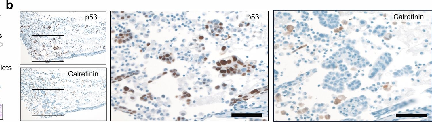 Fig.6.B showing Immunohistochemistry from the publication: Overcoming platinum-resistant ovarian cancer targeting the activated JAK-STAT pathways via extracellular vesicles.