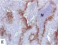 Fig.1.E showing Immunohistochemistry in a Homo sapiens (Human) sample from the publication: Expression of hypoxic marker carbonic anhydrase IX predicts poor prognosis in resectable hepatocellular carcinoma.