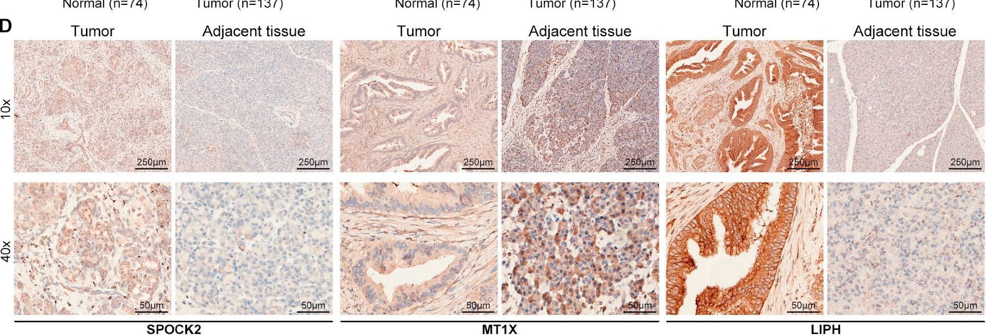 Fig.7.D showing Immunohistochemistry in a Homo sapiens (Human) sample from the publication: Identification and Validation of T-Cell Exhaustion Signature for Predicting Prognosis and Immune Response in Pancreatic Cancer by Integrated Analysis of Single-Cell and Bulk RNA Sequencing Data.