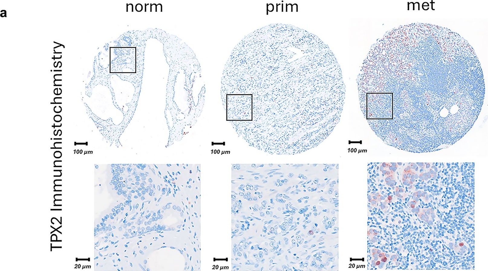 Fig.7.A showing Immunohistochemistry from the publication: Unravelling TPX2-centered co-expression networks as key drivers of aggressive prostate cancer.