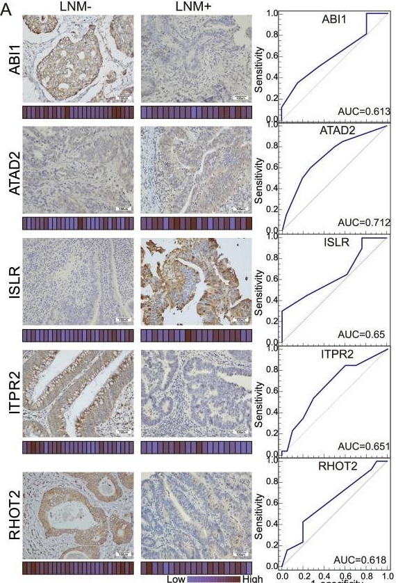 Fig.4.A showing Immunohistochemistry from the publication: Proteomic characteristics reveal the signatures and the risks of T1 colorectal cancer metastasis to lymph nodes.