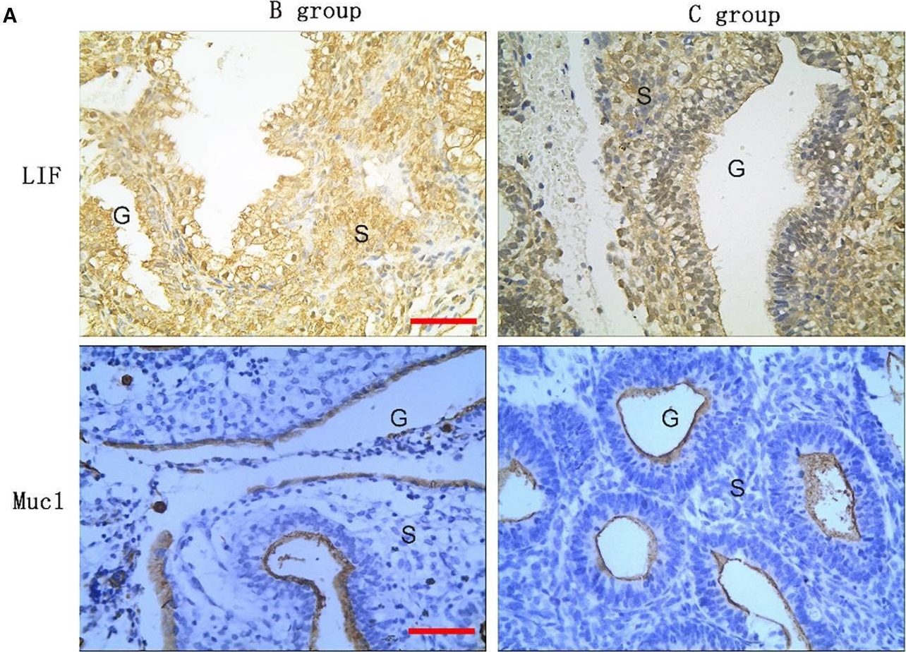 Fig.4.A showing Immunohistochemistry from the publication: Clinical outcomes of different 17β-estradiol drug regimens and their impact on endometrial receptivity.
