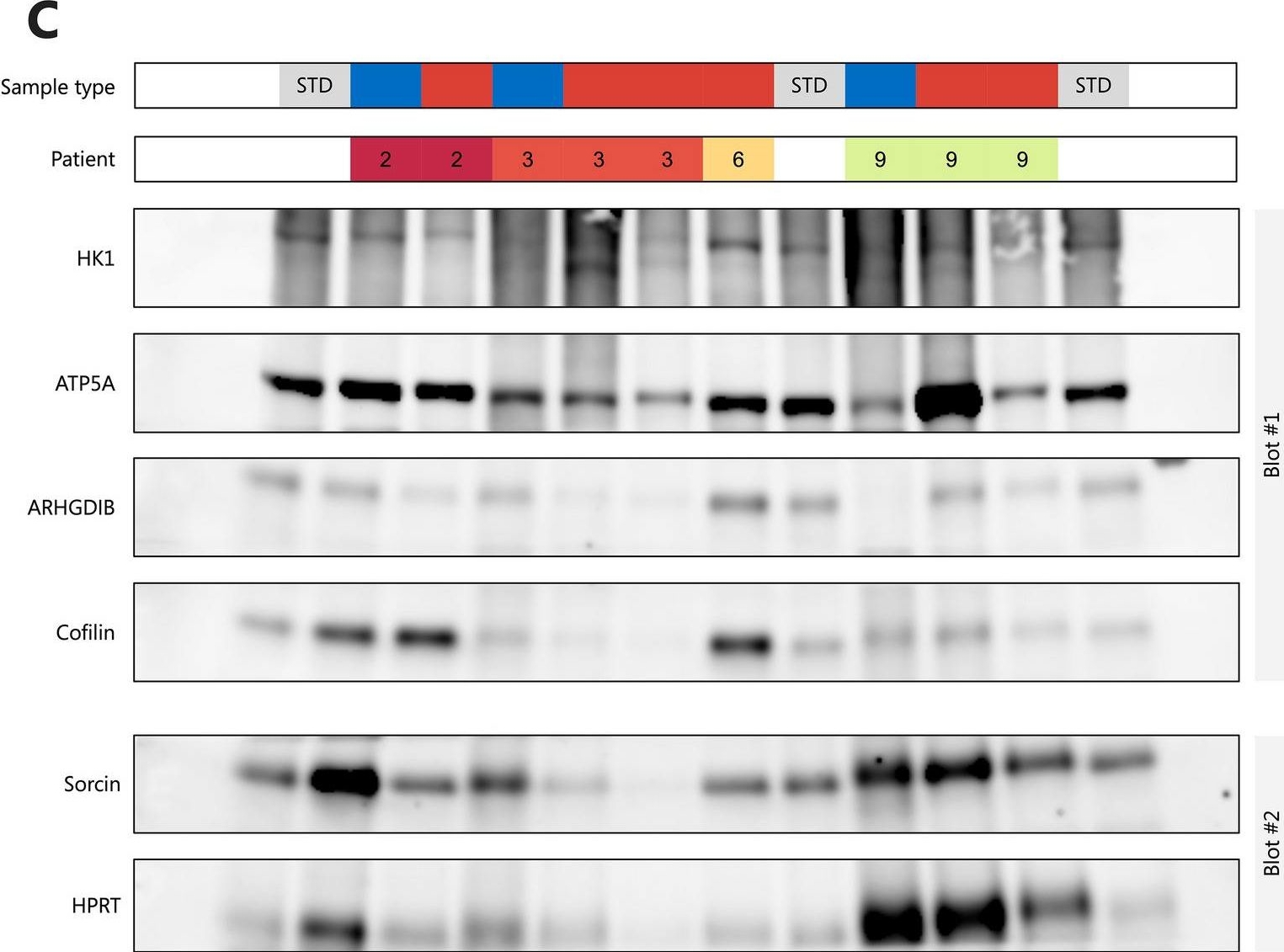 Fig.4.C showing Western Blotting from the publication: Proteomic analyses identify HK1 and ATP5A to be overexpressed in distant metastases of lung adenocarcinomas compared to matched primary tumors.