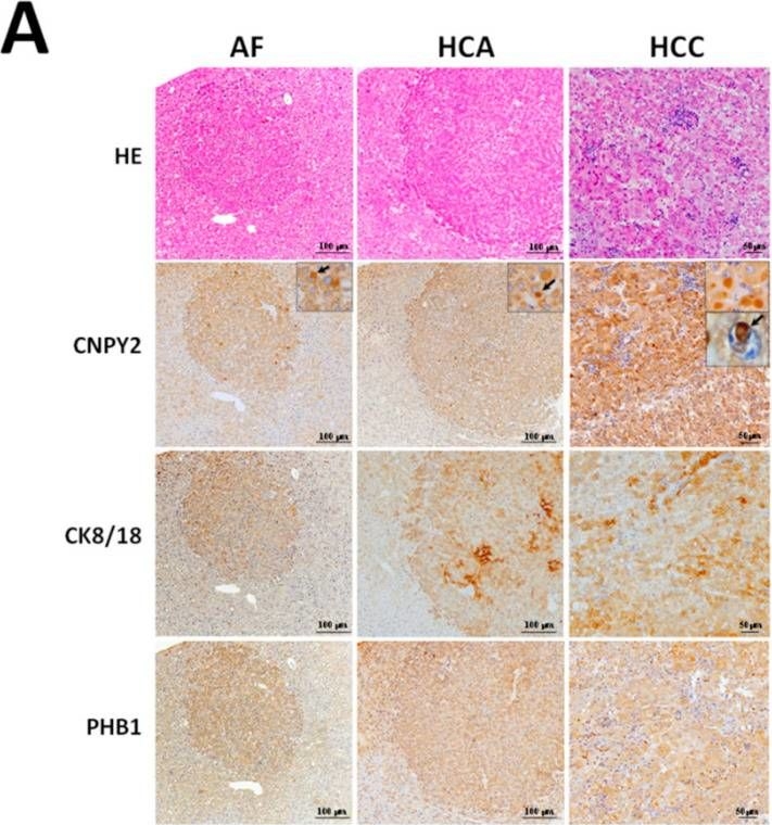 Canopy Homolog 2 as a Novel Molecular Target in Hepatocarcinogenesis.