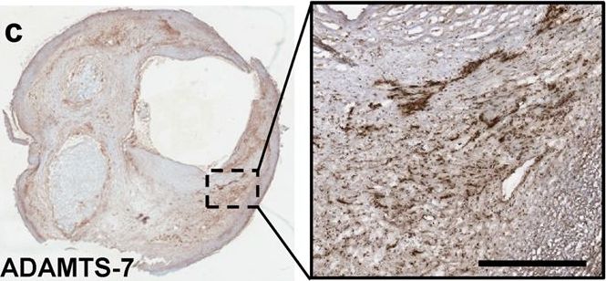 Fig.3.C showing Immunohistochemistry in a Homo sapiens (Human) sample from the publication: ADAMTS-7 is associated with a high-risk plaque phenotype in human atherosclerosis.
