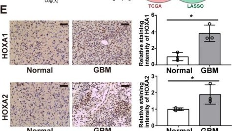 Fig.7.E showing Immunohistochemistry in a Homo sapiens (Human) sample from the publication: Development and validation of a predictive model in diagnosis and prognosis of primary glioblastoma patients based on Homeobox A family.