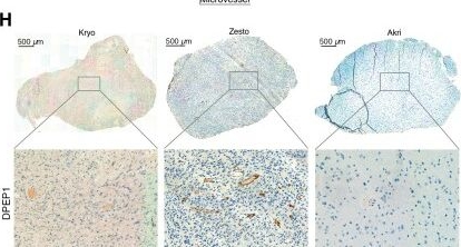 Fig.5.H showing Immunohistochemistry from the publication: Multiomic profiling of glioblastoma metabolic lesions reveals complex intratumoral genomic evolution and dipeptidase-1-driven vascular proliferation.