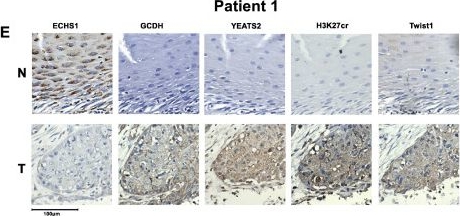 Fig.4.E showing Immunohistochemistry from the publication: Interplay of YEATS2 and GCDH regulates histone crotonylation and drives EMT in head and neck cancer.