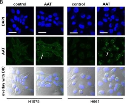 Fig.5.B showing Immunocytochemistry-immunofluorescence in a Homo sapiens (Human) sample from the publication: Clinical Significance of SERPINA1 Gene and Its Encoded Alpha1-antitrypsin Protein in NSCLC.