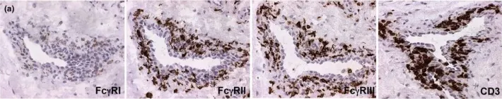 Fig.5.B showing Immunohistochemistry from the publication: High synovial expression of the inhibitory FcgammaRIIb in rheumatoid arthritis.