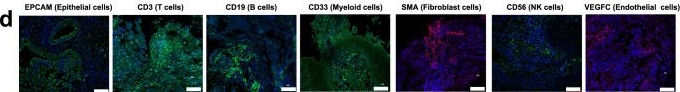 Fig.1.D showing Immunohistochemistry-immunofluorescence in a Homo sapiens (Human) sample from the publication: Single-cell transcriptomic analyses of tumor microenvironment and molecular reprograming landscape of metastatic laryngeal squamous cell carcinoma.