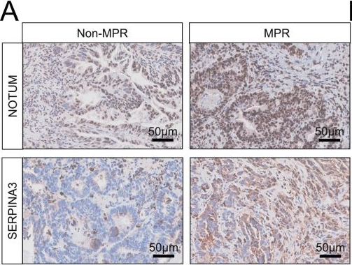 Fig.6.A showing Immunohistochemistry in a Homo sapiens (Human) sample from the publication: Characterization of the tumor microenvironment in locally advanced gastric cancer and identification of spatially predictive biomarkers associated with beneficial neoadjuvant immunochemotherapy.