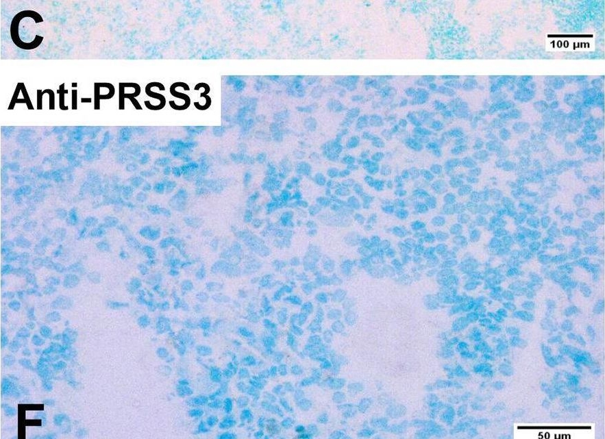Fig.4.C showing Immunohistochemistry from the publication: Combined serine protease PRSS22 and CEA mRNA analysis identifies the majority of colon cancer patients that recur within 12 years.