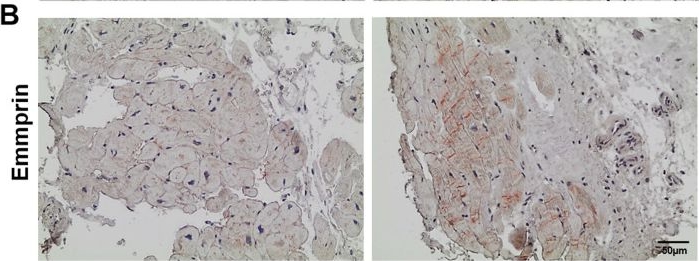 Fig.4.B showing Immunohistochemistry in a Homo sapiens (Human) sample from the publication: Cellular and extracellular proteomic profiling of paradoxical low-flow low-gradient aortic stenosis myocardium.