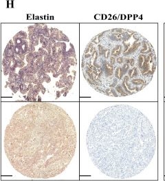 Fig.4.H showing Immunohistochemistry from the publication: CD26 as a potential therapeutic target for lung adenocarcinoma.