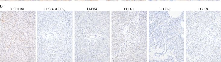 Fig.5.D showing Immunohistochemistry from the publication: Deep proteogenomic characterization of pancreatic solid pseudopapillary neoplasm reveals unique features distinct from other pancreatic tumors.