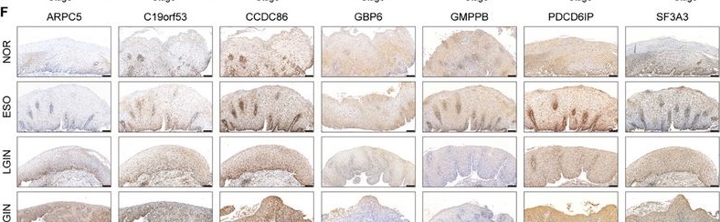 Fig.5.F showing Immunohistochemistry in a Homo sapiens (Human) sample from the publication: Spatio-Temporal Proteomic Landscape Reveals Early Warning Signals of Esophageal Squamous Cell Carcinoma Progression.
